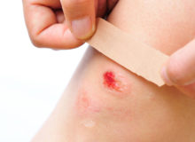 ¿Cómo desinfectar heridas?