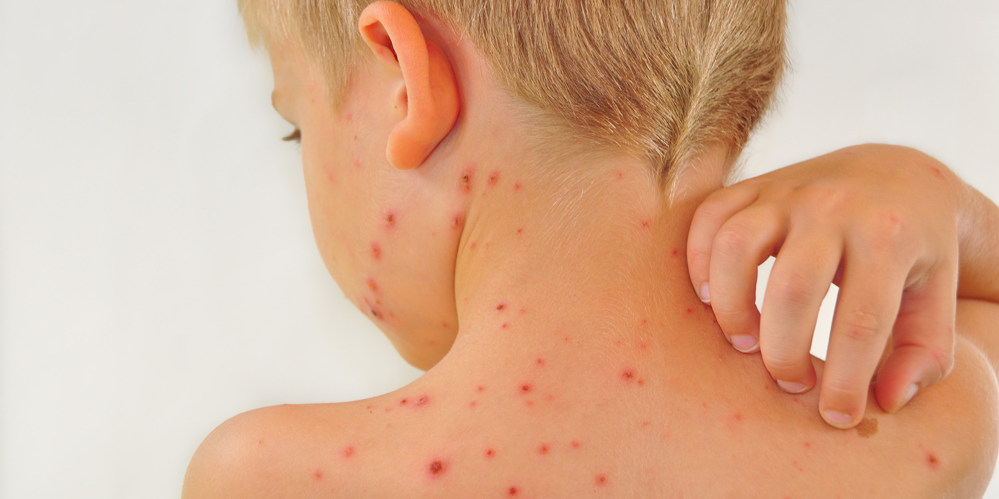 Tratamiento de la varicela en niños